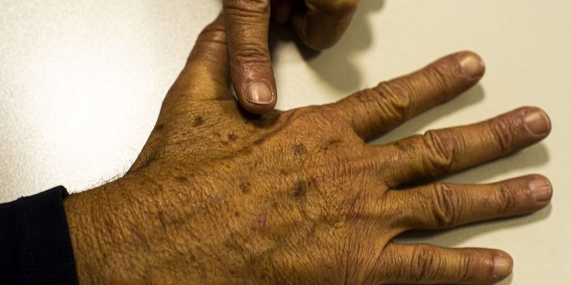 Sociedade médica lança campanha sobre prevenção do câncer de pele