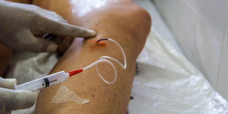 A cada dia, 145 mulheres são internadas para tratar varizes