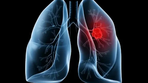 Saiba o que é adenocarcinoma pulmonar, câncer que atinge o Papa Leão